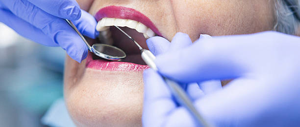 Best Knocked-Out Tooth (Avulsed Tooth) Treatment in East Hemet, CA